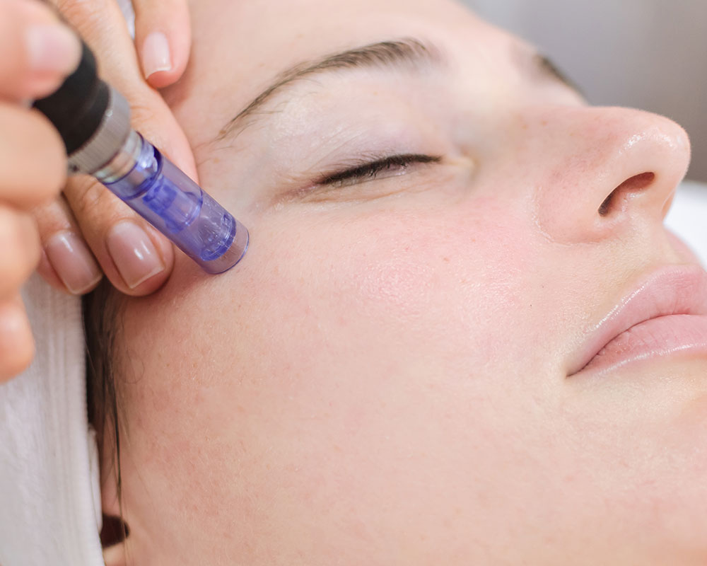 microneedling-1000px microneedling-1000px